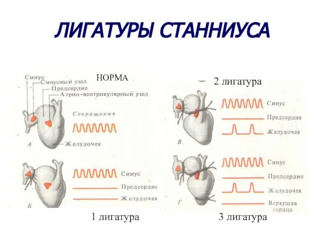 ЛИГАТУРЫ СТАННИУСА НОРМА 1 лигатура 2 лигатура 3 лигатура