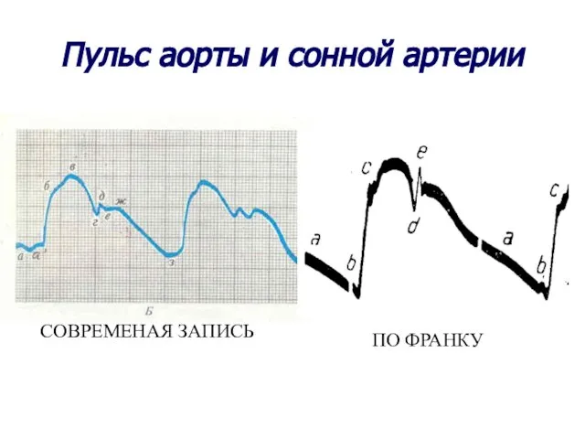 Пульс аорты и сонной артерии СОВРЕМЕНАЯ ЗАПИСЬ ПО ФРАНКУ