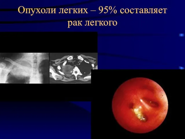 Опухоли легких – 95% составляет рак легкого