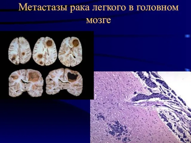 Метастазы рака легкого в головном мозге