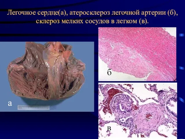 Легочное сердце(а), атеросклероз легочной артерии (б), склероз мелких сосудов в легком (в). а б в