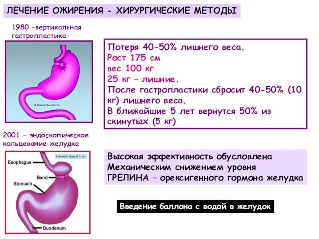 ЛЕЧЕНИЕ ОЖИРЕНИЯ - ХИРУРГИЧЕСКИЕ МЕТОДЫ 1980 –вертикальная гастропластика 2001 – эндоскопическое