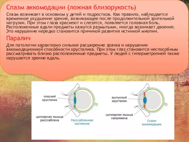 Спазм аккомодации (ложная близорукость) Спазм возникает в основном у детей и