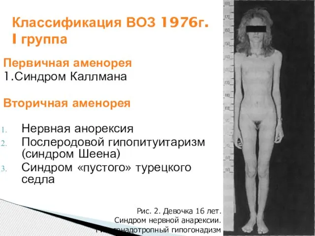 Классификация ВОЗ 1976г. I группа Первичная аменорея 1.Синдром Каллмана Вторичная аменорея