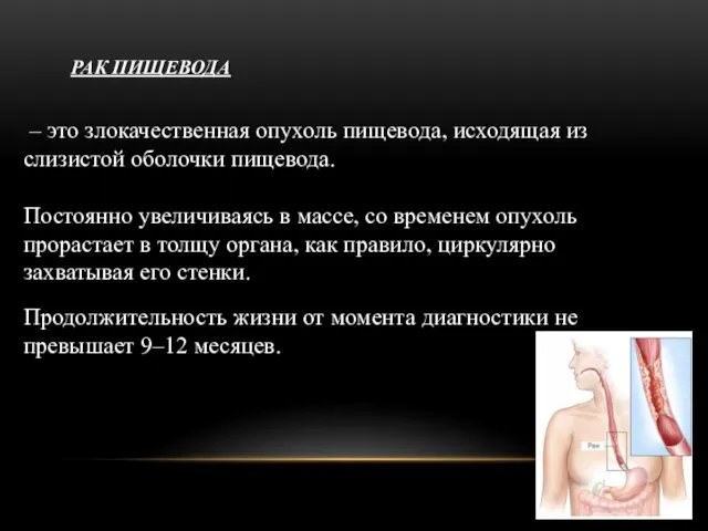 РАК ПИЩЕВОДА – это злокачественная опухоль пищевода, исходящая из слизистой оболочки