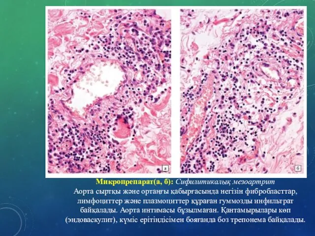 Микропрепарат(а, б): Сифилитикалық мезоартрит Аорта сыртқы және ортаңғы қабырғасында негізін фибробласттар,