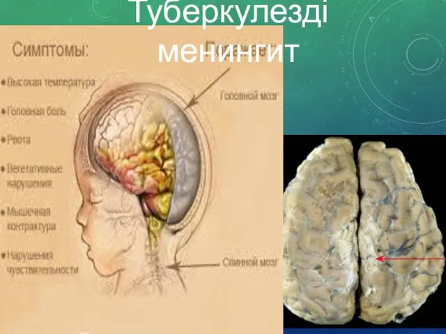 Туберкулезді менингит