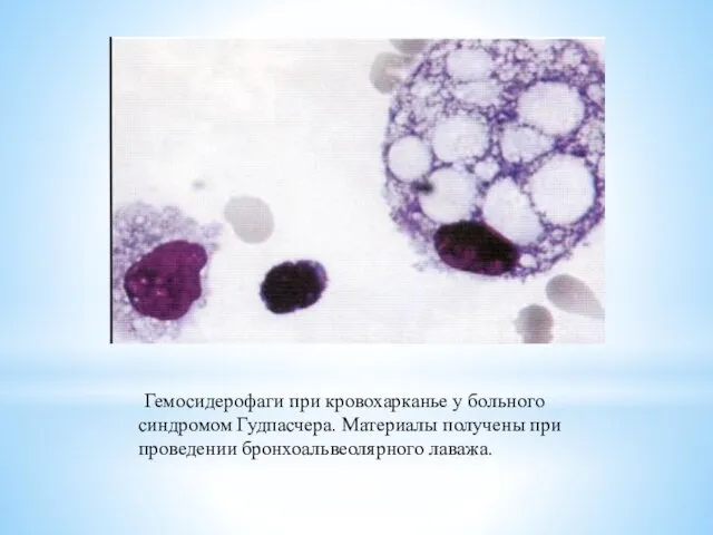 Гемосидерофаги при кровохарканье у больного синдромом Гудпасчера. Материалы получены при проведении бронхоальвеолярного лаважа.