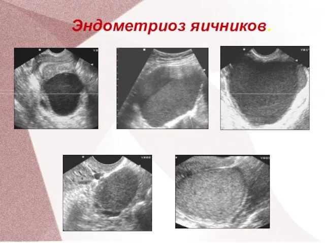 Эндометриоз яичников.