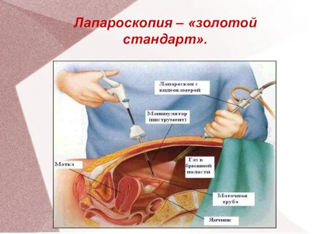 Лапароскопия – «золотой стандарт».