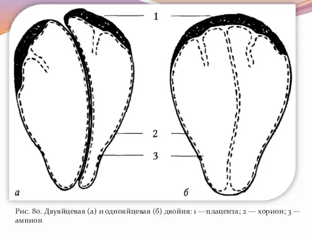 Рис.— амнион Рис. 80. Двуяйцевая (а) и однояйцевая (б) двойня: 1