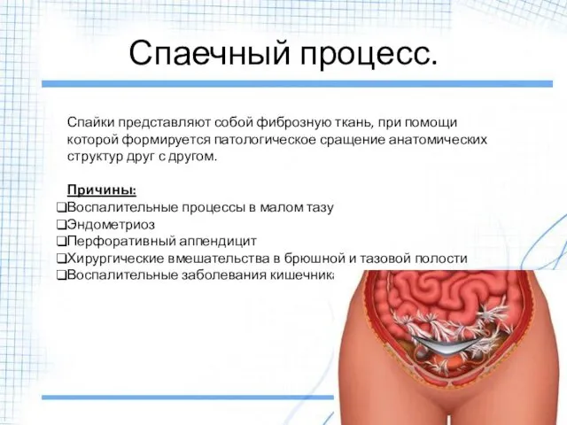 Спаечный процесс. Спайки представляют собой фиброзную ткань, при помощи которой формируется