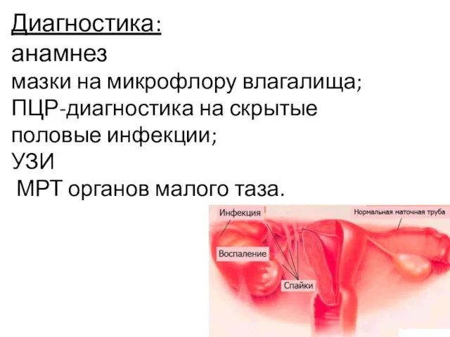 Диагностика: анамнез мазки на микрофлору влагалища; ПЦР-диагностика на скрытые половые инфекции; УЗИ МРТ органов малого таза.