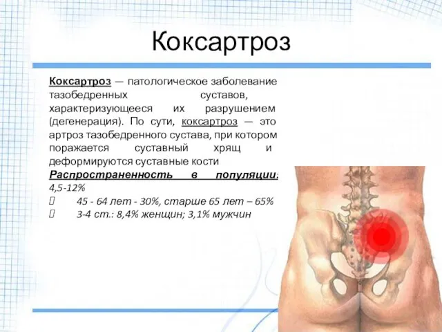 Коксартроз Коксартроз — патологическое заболевание тазобедренных суставов, характеризующееся их разрушением (дегенерация).