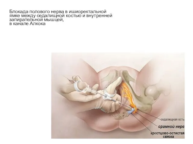 Блокада полового нерва в ишиоректальной ямке между седалищной костью и внутренней запирательной мышцей, в канале Алкока