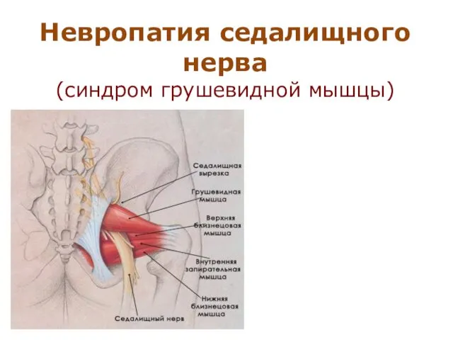 Невропатия седалищного нерва (синдром грушевидной мышцы)