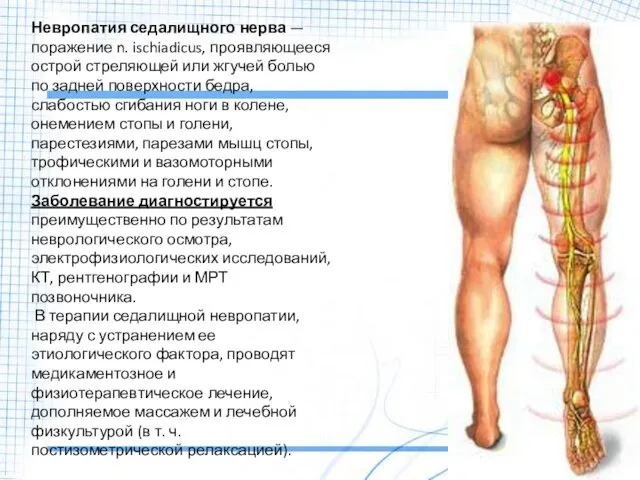 Невропатия седалищного нерва — поражение n. ischiadicus, проявляющееся острой стреляющей или