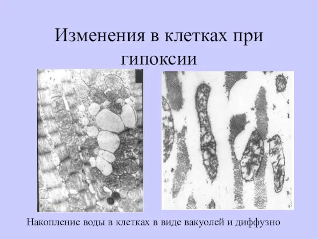 Изменения в клетках при гипоксии Накопление воды в клетках в виде вакуолей и диффузно