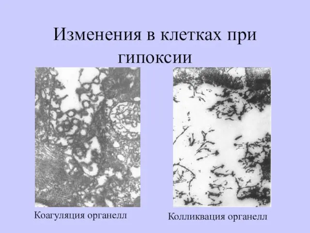 Изменения в клетках при гипоксии Коагуляция органелл Колликвация органелл