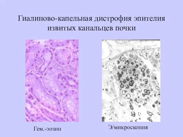 Гиалиново-капельная дистрофия эпителия извитых канальцев почки Гем.-эозин Э/микроскопия