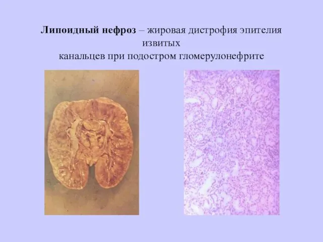 Липоидный нефроз – жировая дистрофия эпителия извитых канальцев при подостром гломерулонефрите