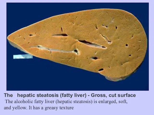 The hepatic steatosis (fatty liver) - Gross, cut surface The alcoholic