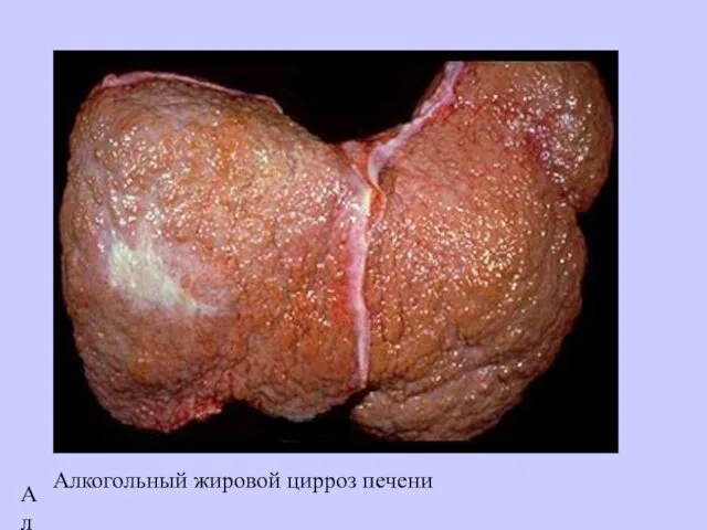 Алкогольный жировой цирроз печени Алкогольный жировой цирроз печени