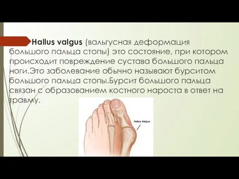 Hallus valgus (вальгусная деформация большого пальца стопы) это состояние, при котором