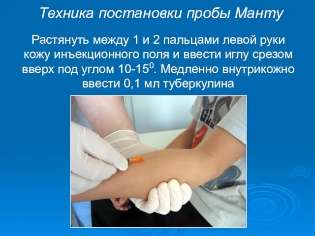 Растянуть между 1 и 2 пальцами левой руки кожу инъекционного поля