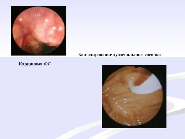 Карцинома ФС Канюлирование дуоденального сосочка