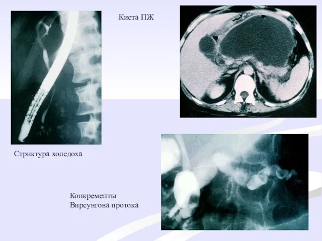 Киста ПЖ Стриктура холедоха Конкременты Вирсунгова протока