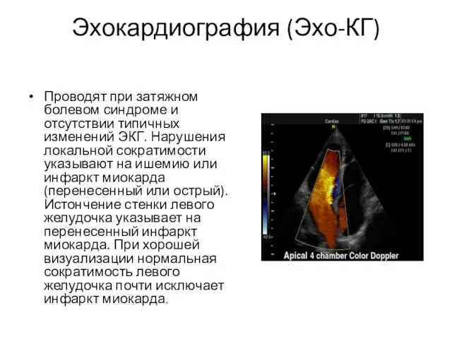 Эхокардиография (Эхо-КГ) Проводят при затяжном болевом синдроме и отсутствии типичных изменений