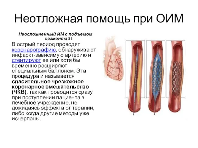 Неотложная помощь при ОИМ Неосложненный ИМ с подъемом сегмента SТ В