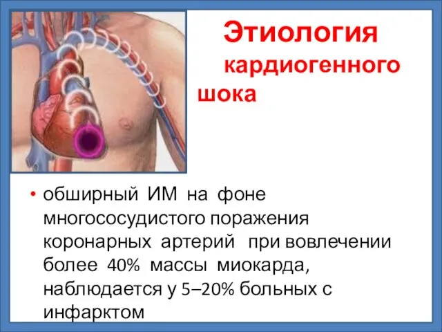 Этиология кардиогенного шока обширный ИМ на фоне многососудистого поражения коронарных артерий