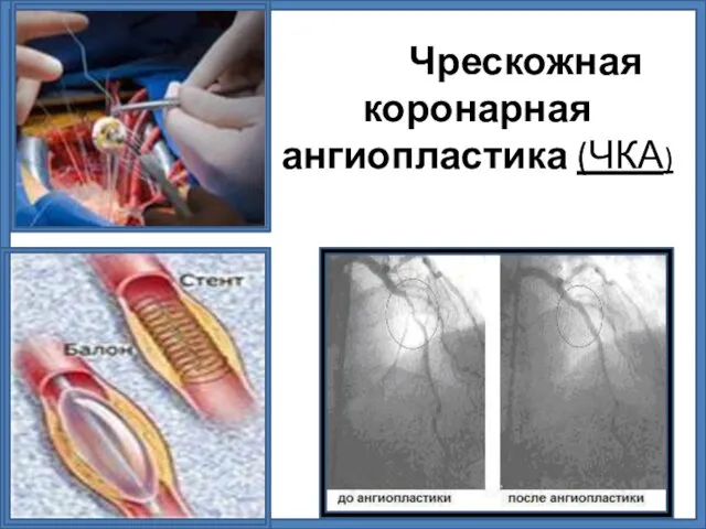 Чрескожная коронарная ангиопластика (ЧКА)