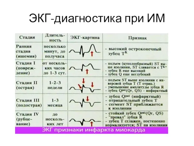 ЭКГ-диагностика при ИМ