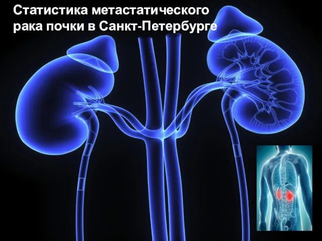 Статистика метастатического рака почки в Санкт-Петербурге
