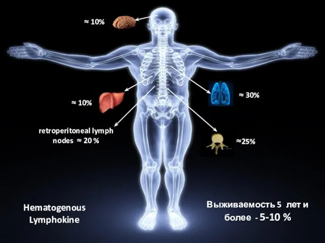 Метастазирование рака почки retroperitoneal lymph nodes ≈ 20 % ≈ 30%