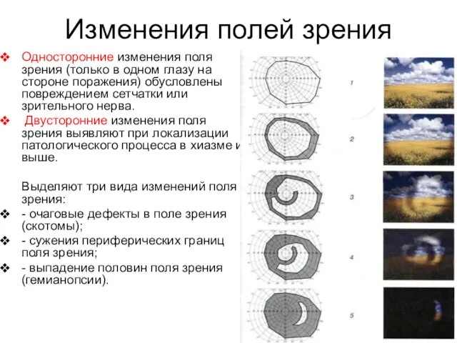 Изменения полей зрения Односторонние изменения поля зрения (только в одном глазу