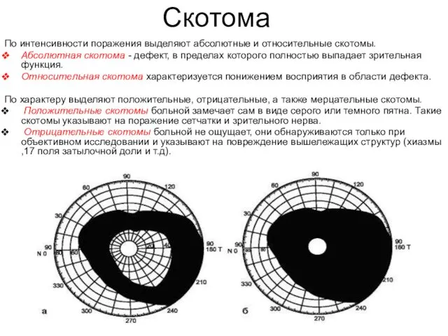 Скотома По интенсивности поражения выделяют абсолютные и относительные скотомы. Абсолютная скотома