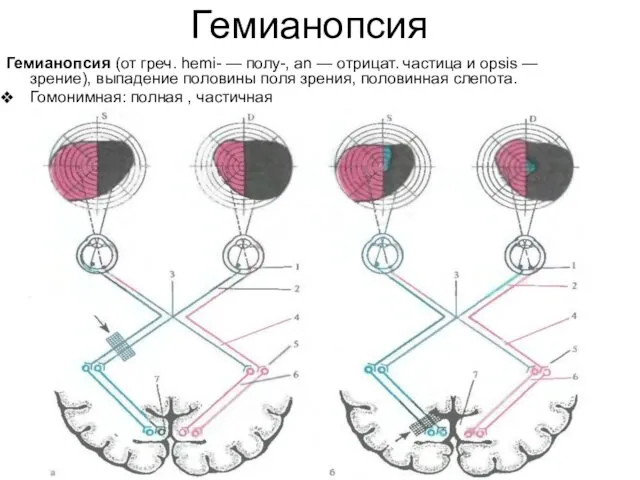 Гемианопсия Гемианопсия (от греч. hemi- — полу-, an — отрицат. частица