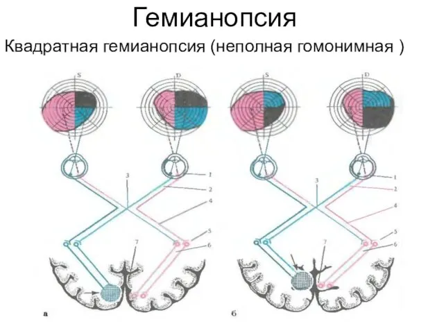 Гемианопсия Квадратная гемианопсия (неполная гомонимная )