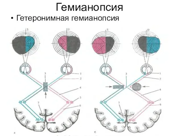 Гемианопсия Гетеронимная гемианопсия