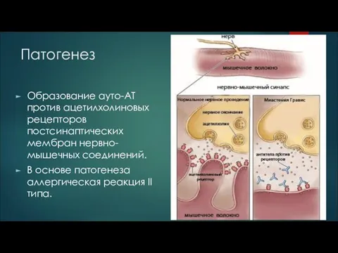 Патогенез Образование ауто-АТ против ацетилхолиновых рецепторов постсинаптических мембран нервно-мышечных соединений. В