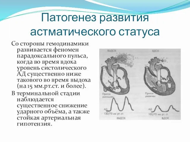 Патогенез развития астматического статуса Со стороны гемодинамики развивается феномен парадоксального пульса,