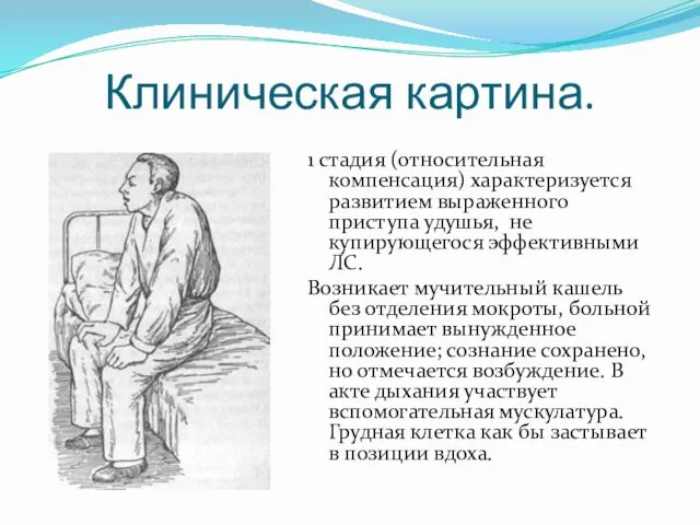 Клиническая картина. 1 стадия (относительная компенсация) характеризуется развитием выраженного приступа удушья,