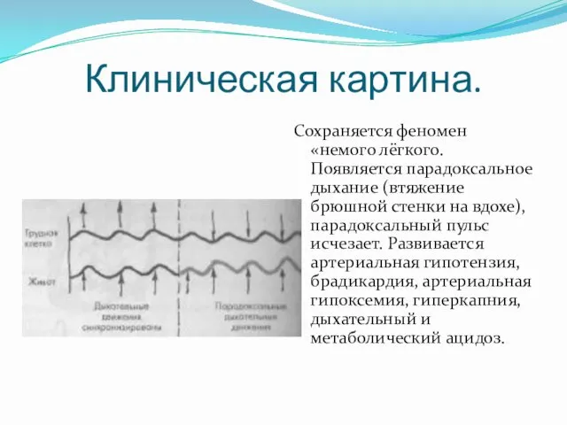 Клиническая картина. Сохраняется феномен «немого лёгкого. Появляется парадоксальное дыхание (втяжение брюшной