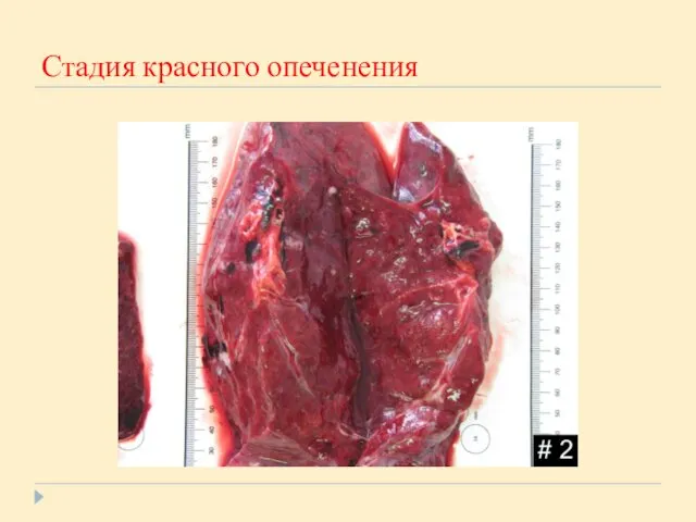 Стадия красного опеченения