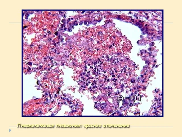 Пневмококковая пневмония: красное опеченение