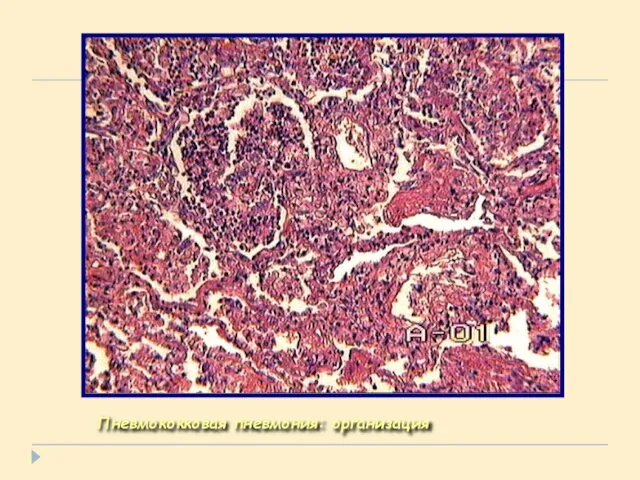 Пневмококковая пневмония: организация
